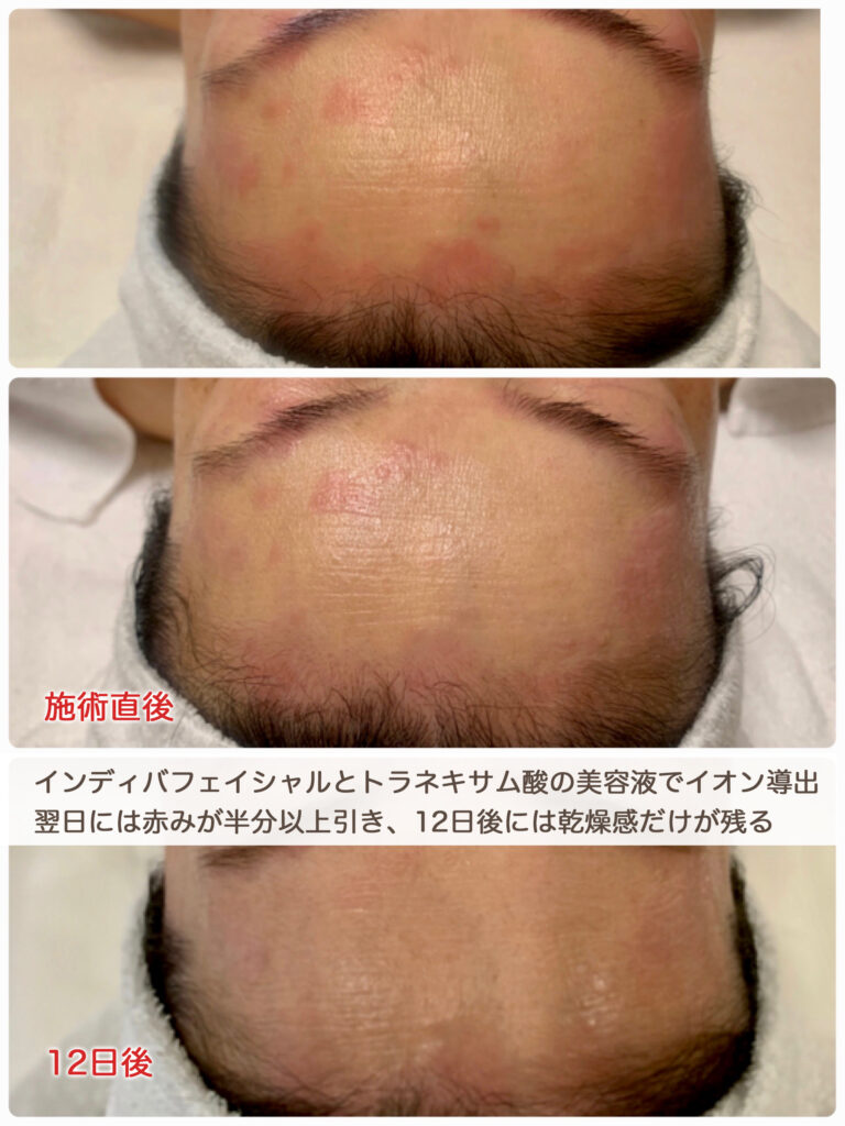アトピー体質の方はインディバでラクになりましょう!_ビューラー大谷ができる施術とご指導