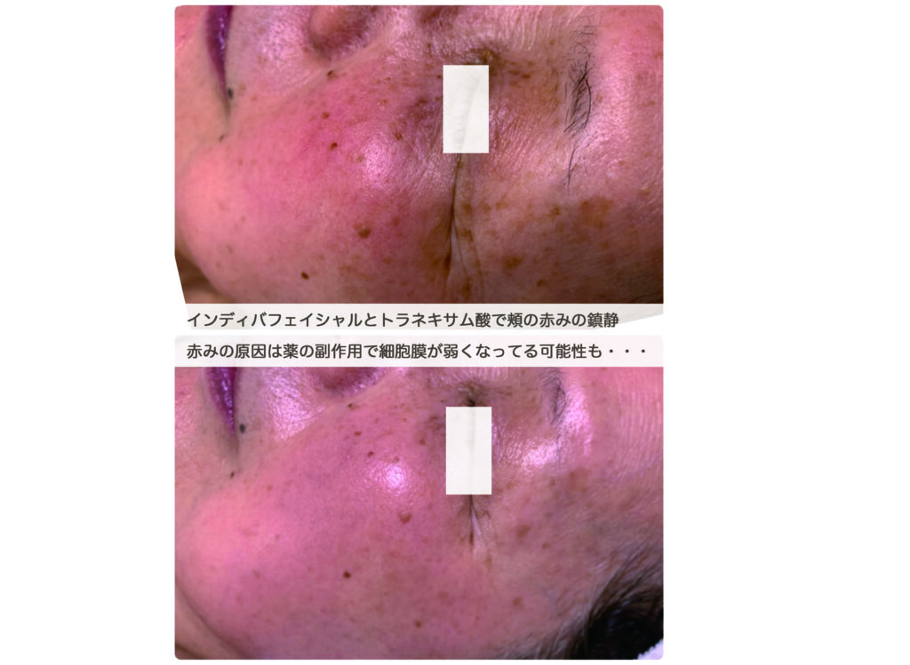 インディバフェイシャルのお客さま_LDLコレステロールは大事なので薬で下げないでね🙌