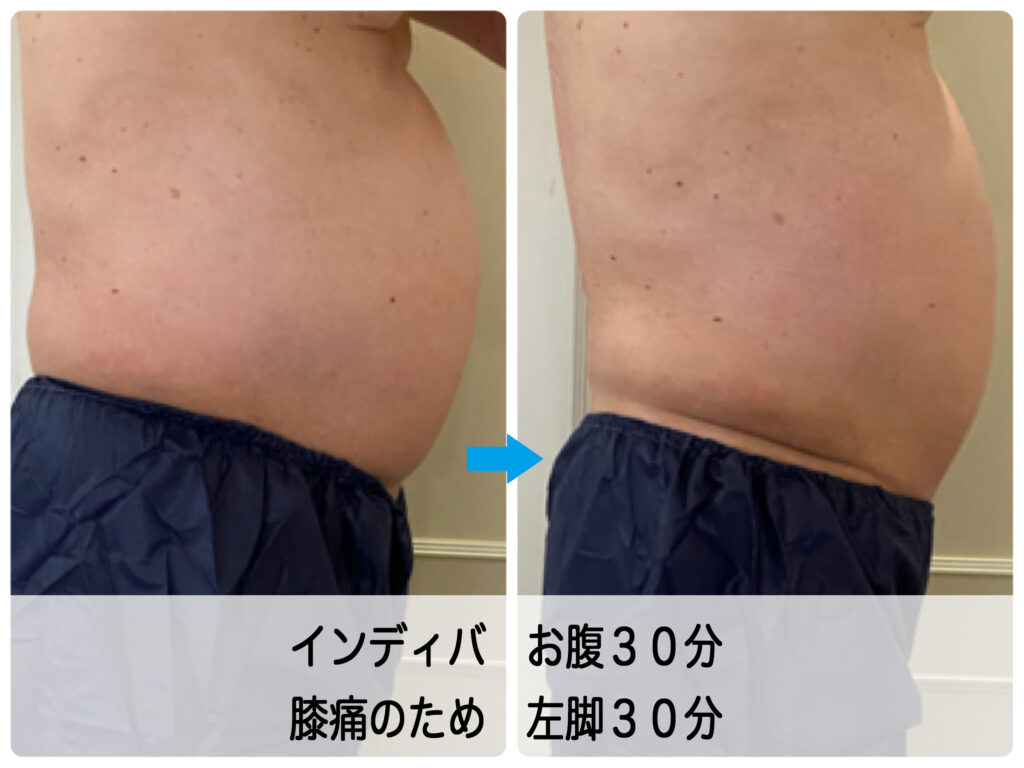 膝痛の男性のお客さま_高血圧と高脂血症の既往症_インディバケア