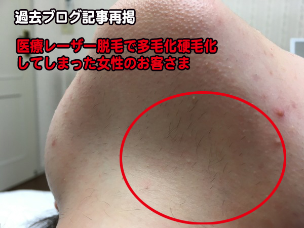医療レーザーや光脱毛で 硬毛化 多毛化 してる方は迷わず美容電気脱毛 針脱毛 へ 医療レーザーや光脱毛で 硬毛化 多毛化 してる方は迷わず美容電気脱毛 針脱毛 へ