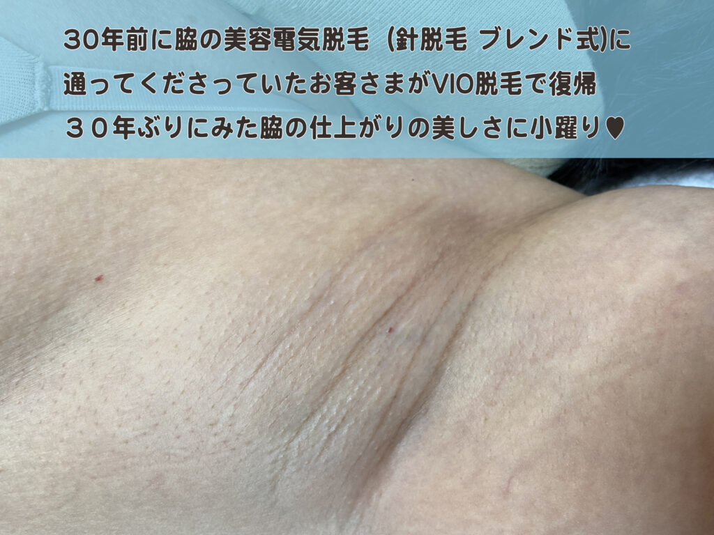 30年ぶりの美容電気脱毛のお客さま   脇を完璧に仕上げた成功体験から今度はVIOへ