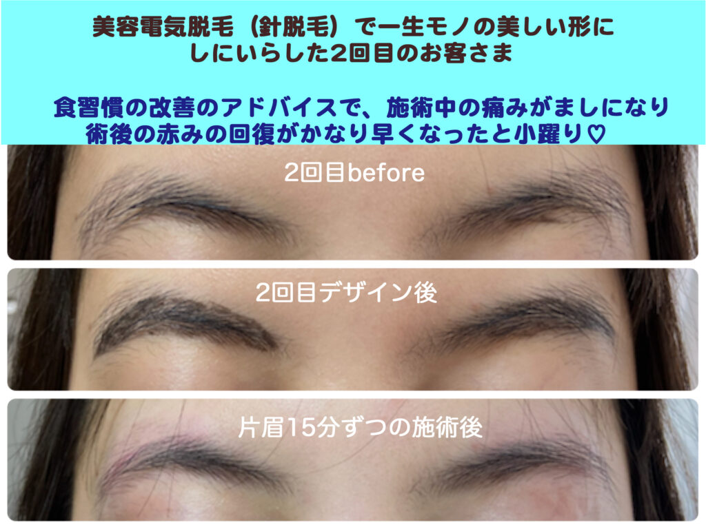 美容電気脱毛で一生お手入れの要らない眉へ!_タンパク質を増やして脱毛の痛みが軽減したお客さま