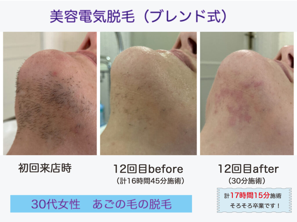女性のあごの濃い毛を最初から美容電気脱毛(針脱毛_ブレンド式)でなさった方