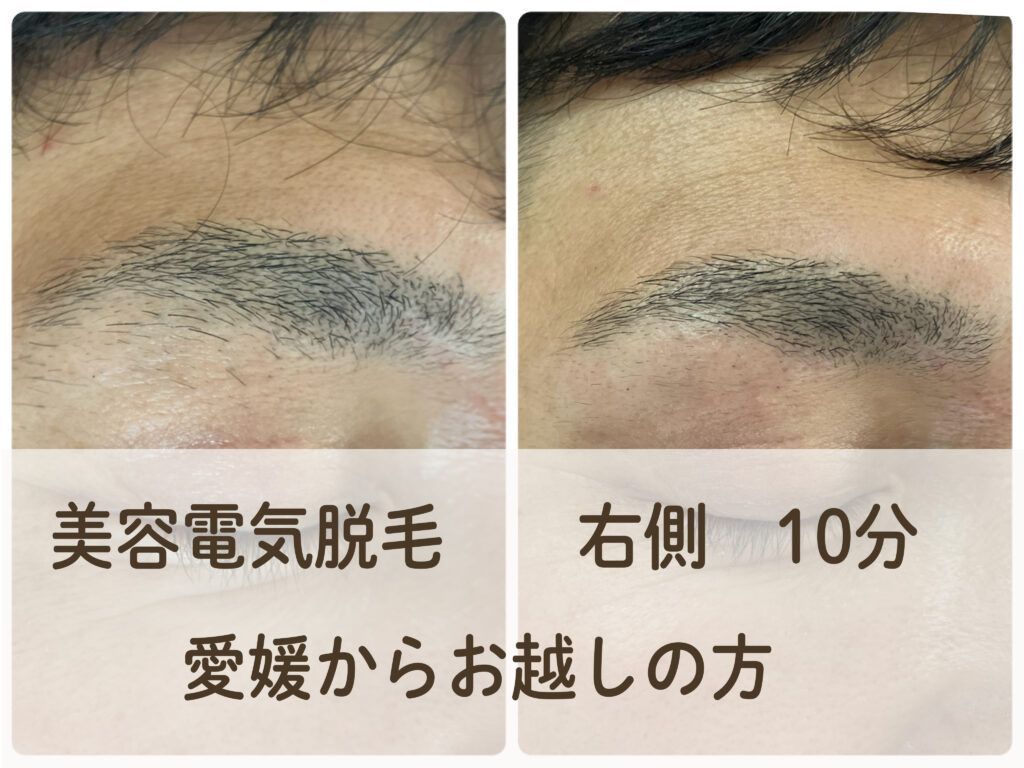 美容電気脱毛で眉毛のデザインやレーザーの取り残しの施術_愛媛からお越しの方__肌質体質改善エステ・ビューラー大谷