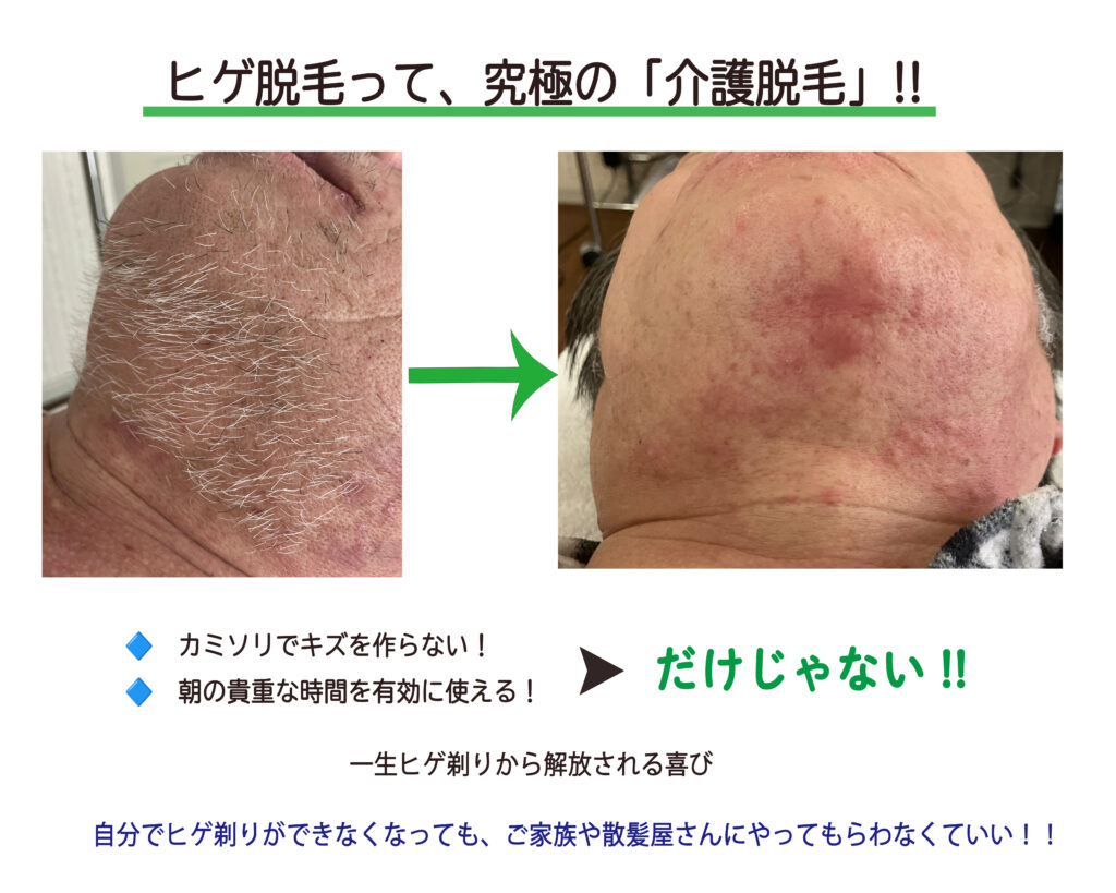 ヒゲ脱毛って実は、究極の介護脱毛じゃない?🙌__肌質体質改善エステ_ビューラー大谷