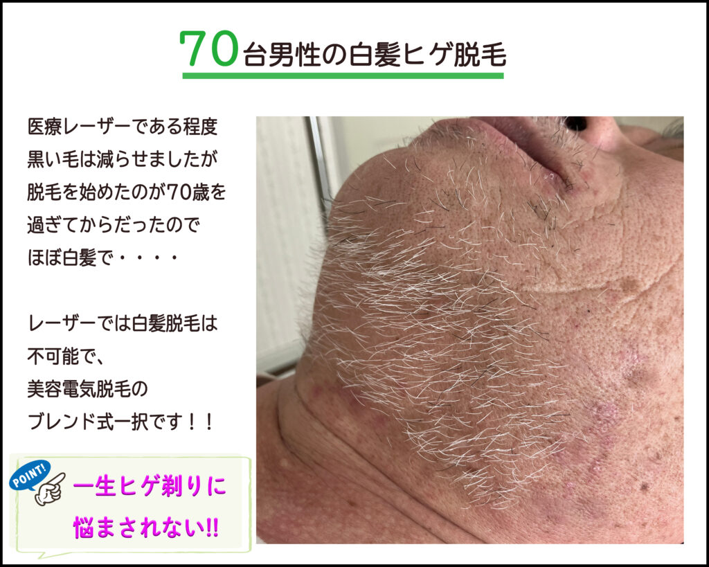 レーザー脱毛による多毛化硬毛化、白髪の脱毛はエステの「終わり